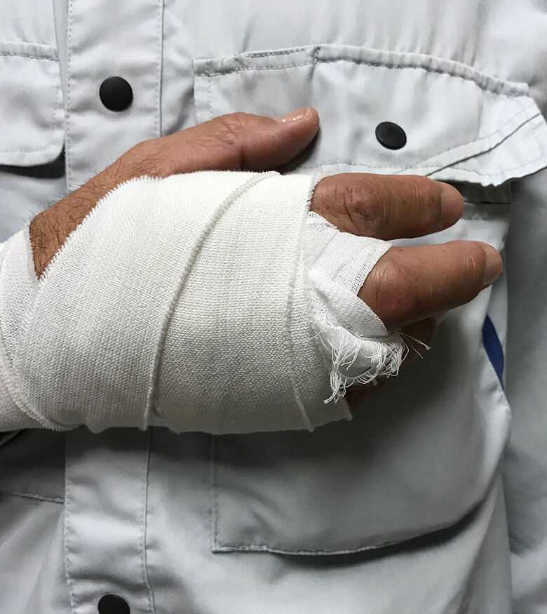 Workers’ Compensation Lawyers in Sarasota, Florida (FL) - Man with injured hand