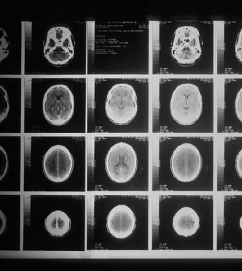 Prestonsburg Brain Injury Attorneys - brain scans with injuries