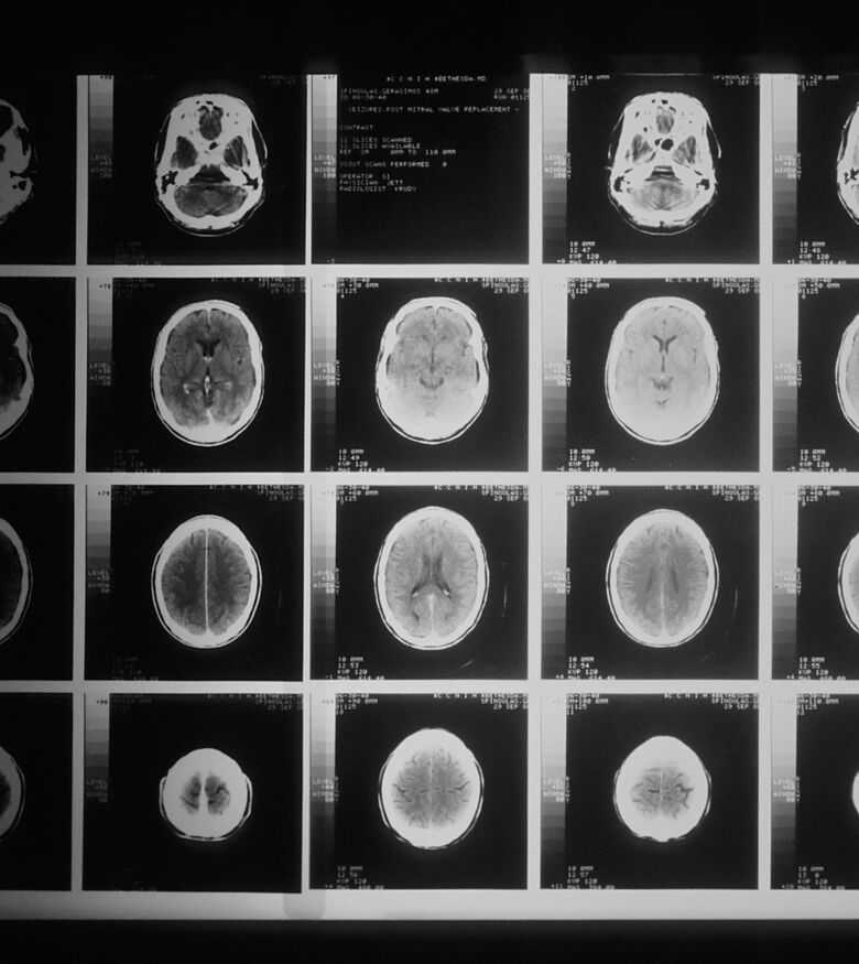 Louisville Brain Injury Attorneys - brain scan injuries 