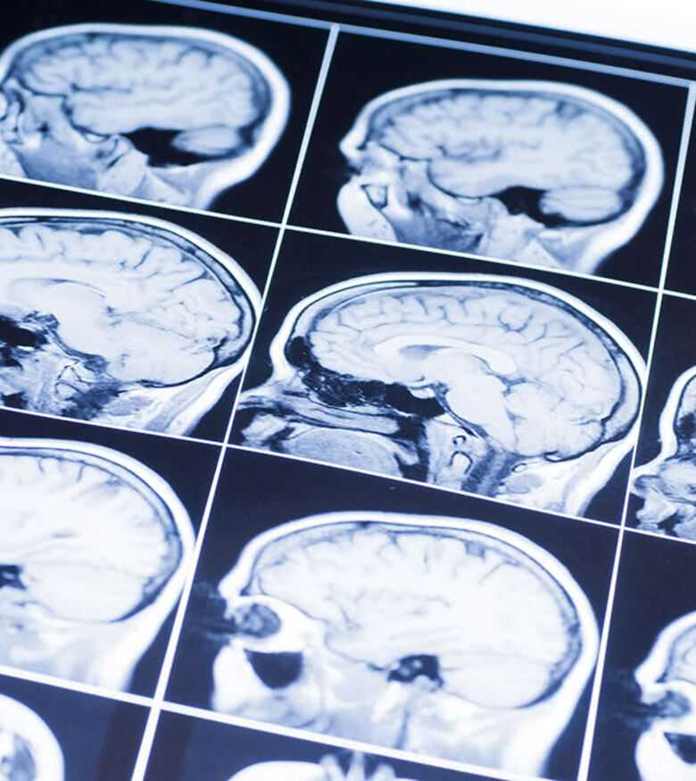 Naples Brain Injury Attorneys - brain scan with injuries