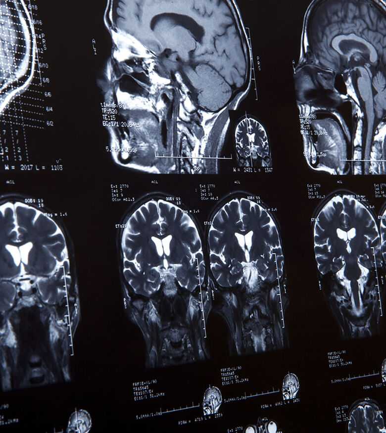 Brain Injury Attorneys in Columbus, GA - Brain injury Scan
