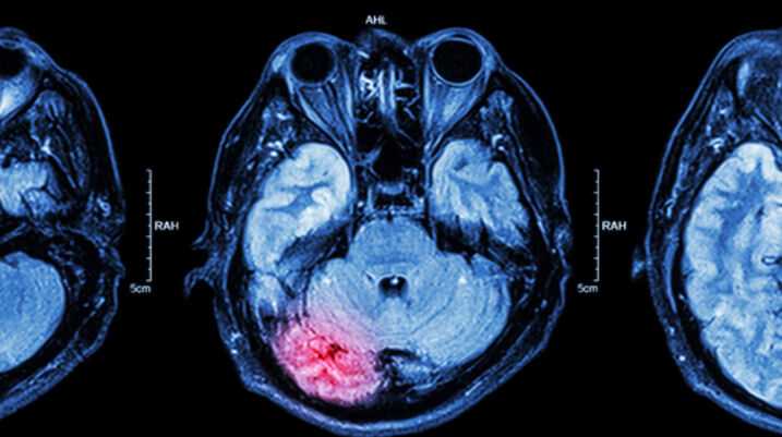 Concussions, Brain Injuries on the Rise in Youth - brain injury scan