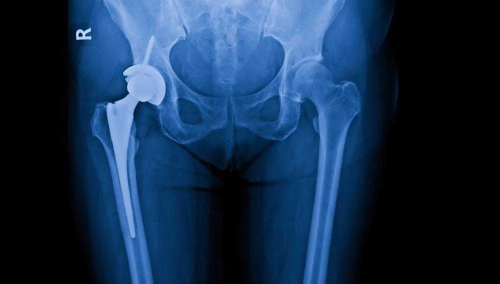 X-ray of a hip replacement