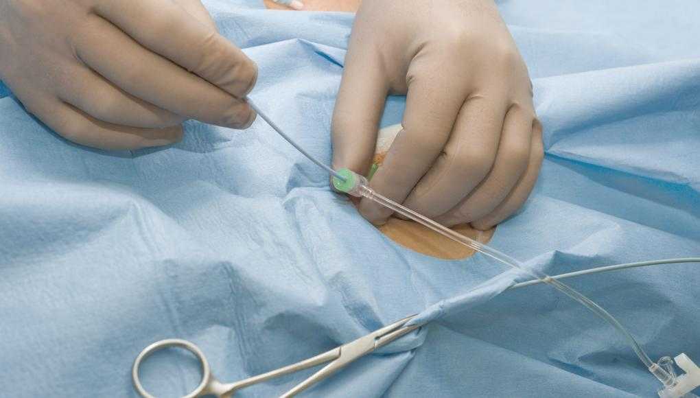 Doctor inserting catheter