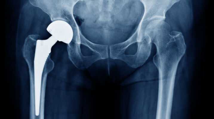 Report: Johnson & Johnson to Settle Metal Hip Implant Suits for $4 Billion - Hip Implant X-Ray