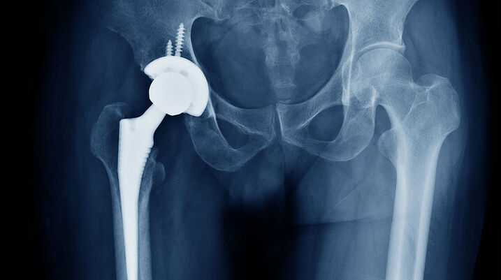 hip replacement lawsuit