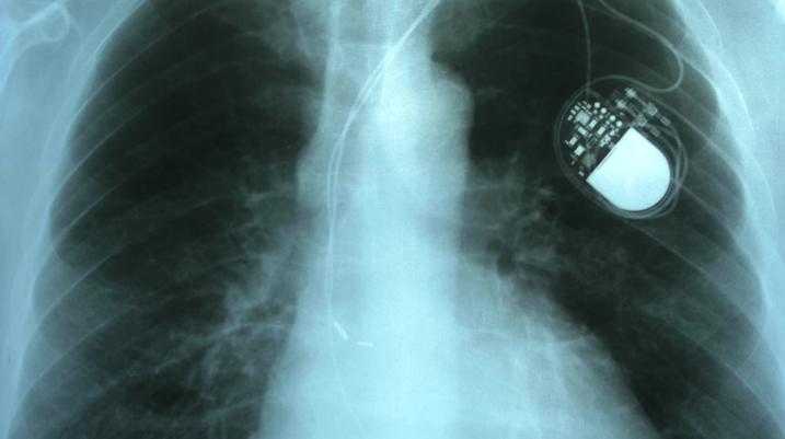 X-ray of a pacemaker