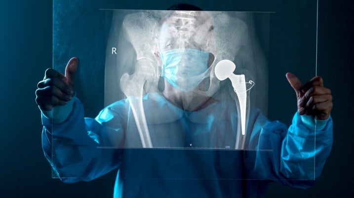 hip replacement