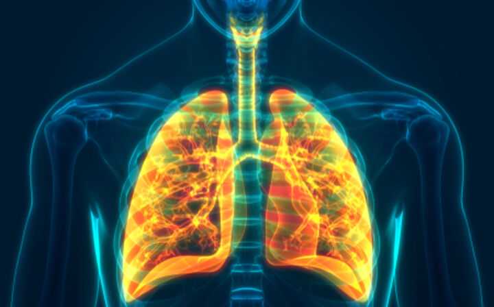 5 Facts About Benign Mesothelioma You Should Know - mesothelioma in the lungs