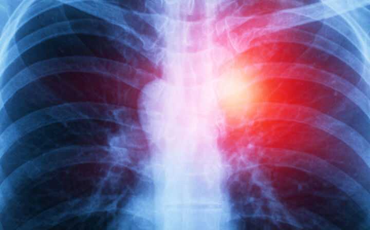 How Many Cases of Mesothelioma Are Diagnosed Each Year - mesothelioma in the lungs
