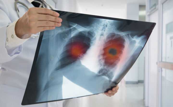 Stage 2 Mesothelioma: Facts & Info - mesothelioma scans