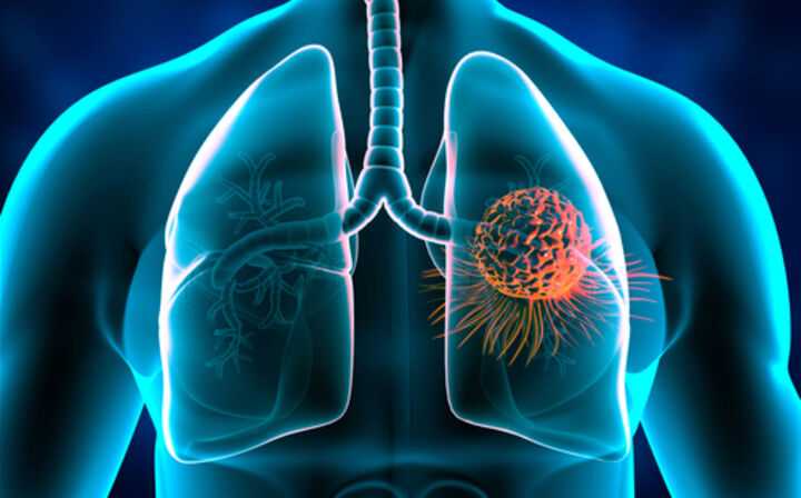 What Parts of the Body Does Mesothelioma Affect - lung scan