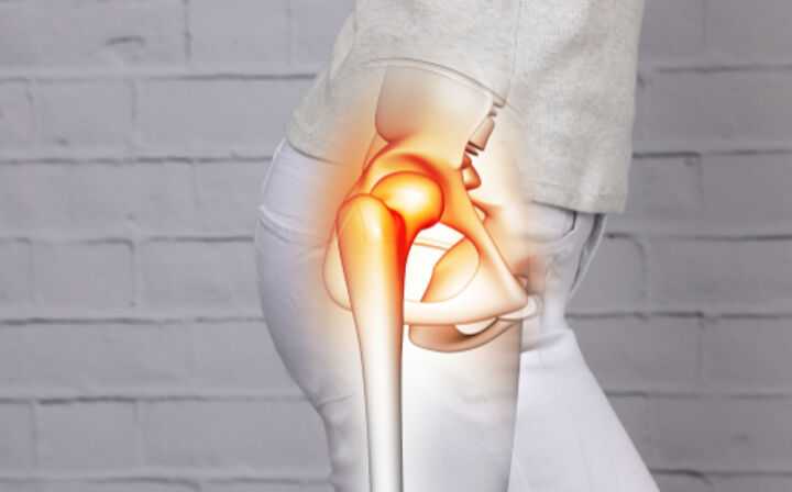 Wright Conserve Hip Replacement Lawsuit - hip pain