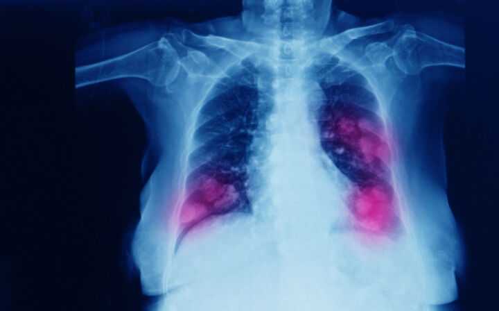 Mesothelioma: What Is the Average Life Expectancy? - lung scans