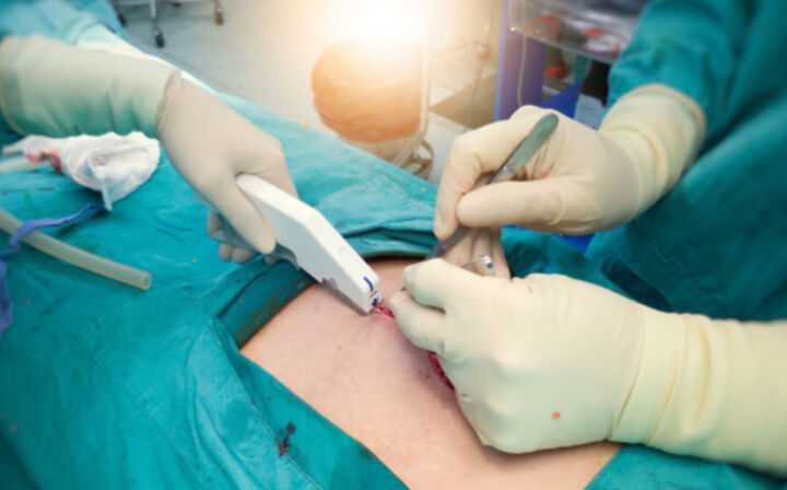 Surgical Stapler Lawsuit - surgery