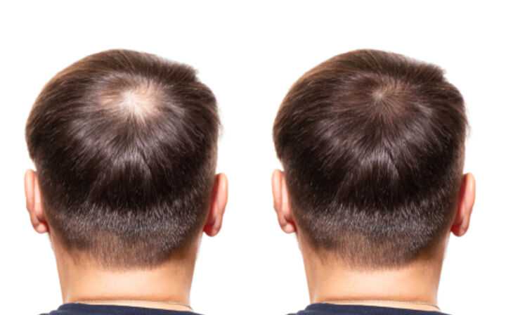 What Is the Hair Loss Suit Process - hair loss