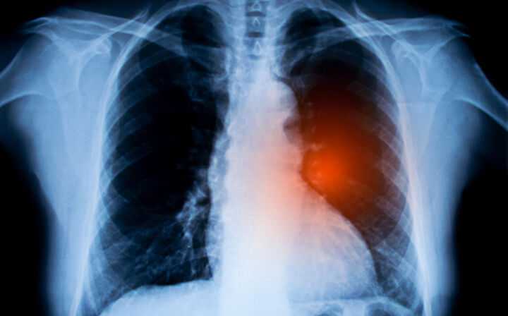 An Overview of Mesothelioma Treatment Options - mesothelioma in the lungs