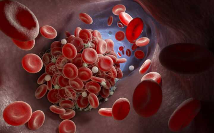 IVC Blood Clot Filter Lawsuit - blood clot