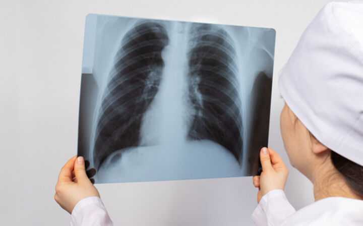A Mesothelioma Lawyer Can Help You Receive Compensation - mesothelioma in the lungs scan