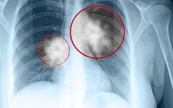 What Are the Symptoms of Asbestos Poisoning - mesothelioma lung scan