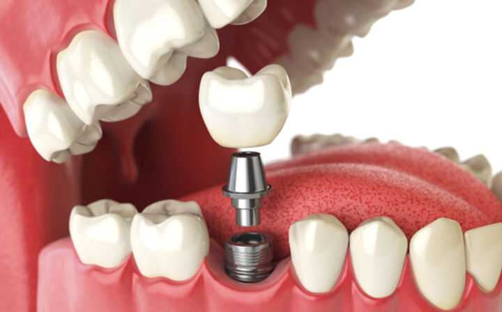 Dental Implant Malpractice Lawyers - teeth