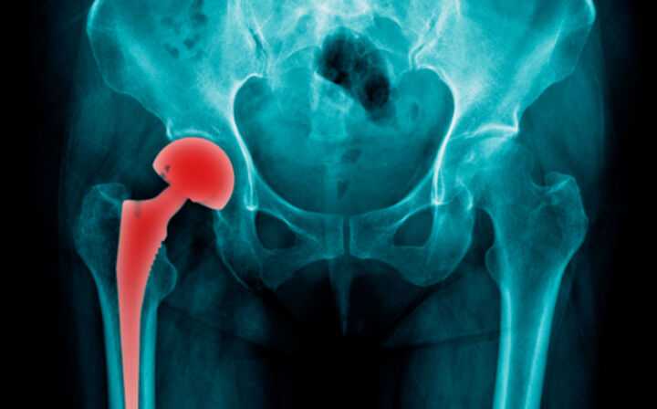 DePuy Hip Implant Recall - hip scan