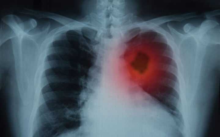 Finding the Right Mesothelioma Lawyer - mesothelioma in lungs