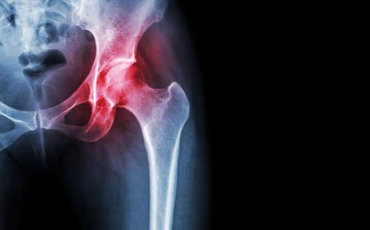 Zimmer Biomet Hip Replacement Lawsuit - hip pain scan