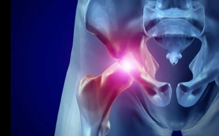 DePuy Pinnacle Hip Replacement Lawsuit - hip pain