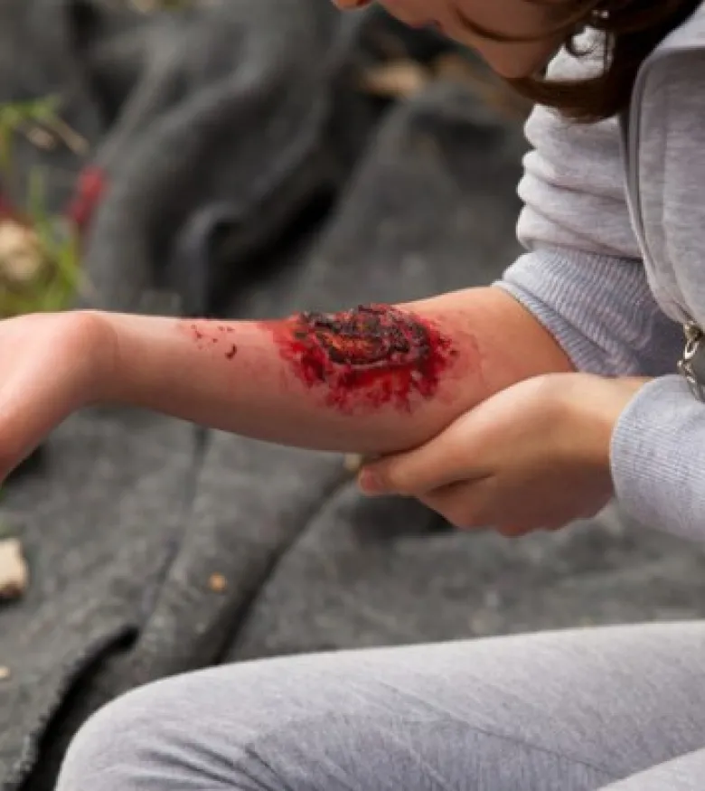 Deland, FL Burn Injury Lawyers - woman with burn on arm.