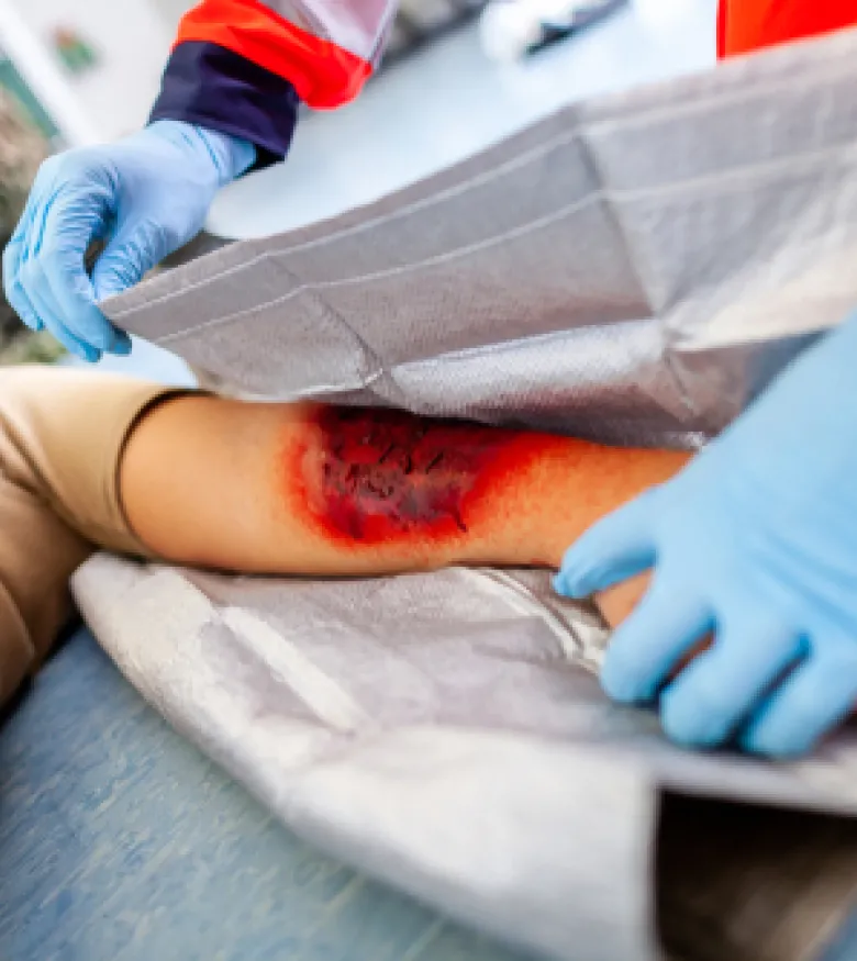 Burn Injury Lawyers in Big Pine Key
