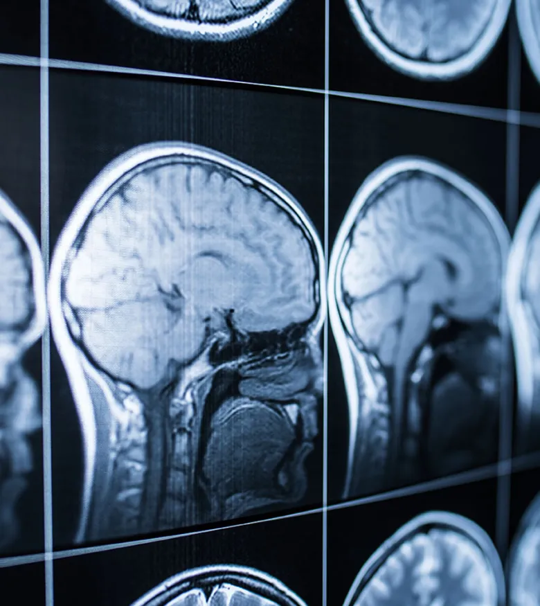 Birmingham Brain Injury Attorneys - Brain injury scan