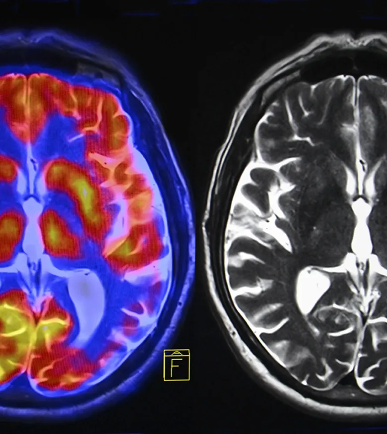 Brain Injury Lawyers in Orlando, FL - Brain scan