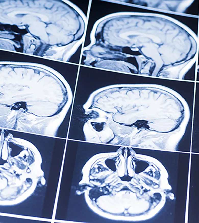 Atlanta Children's Brain Injury Lawyers - Child Brain Injury scan
