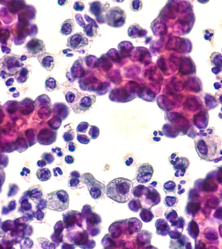 Find a Mesothelioma Lawyer in Memphis - Mesothelioma cells