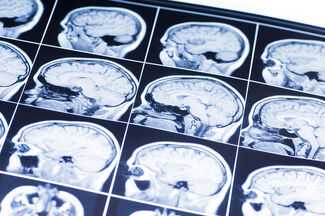 Brain Injury Lawyers in Houston, TX - Brain Scans