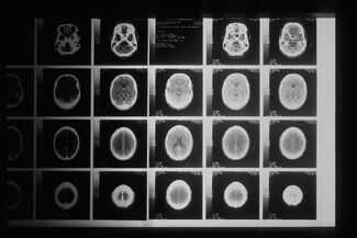Fort Lauderdale Brain Injury Attorneys - brain scan with injuries