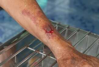 Palm Harbor, FL Burn Injury Lawyers - Arm with Burn Injury 