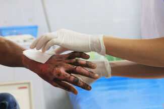 Owensboro, KY Burn Injury Lawyers - Nurse patching burn injury