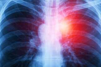 Mesothelioma Attorneys in Pittsburgh