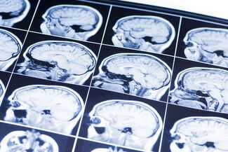 Brain Injury Lawyers in Atlanta, GA - brain injury scan