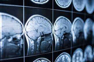 Birmingham Brain Injury Attorneys - Brain injury scan