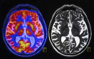 Brain Injury Lawyers in Orlando, FL - Brain scan
