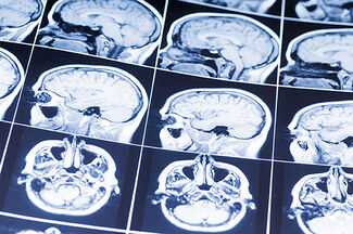 Atlanta Children's Brain Injury Lawyers - Child Brain Injury scan