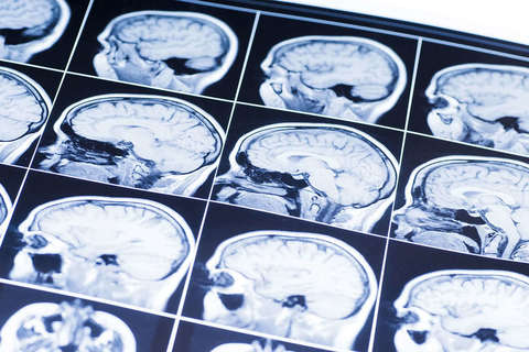 Brain Injuries
